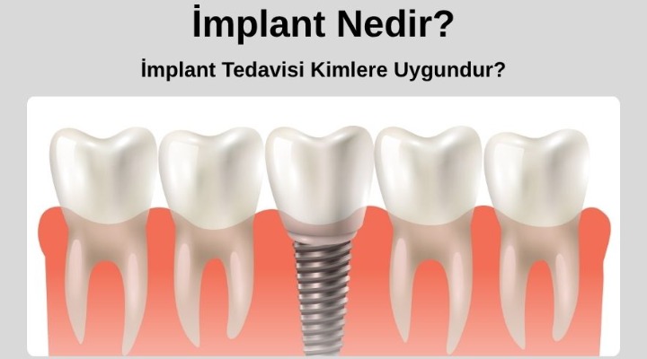 İmplant Nedir? İmplant Tedavisi Kimlere Uygundur?