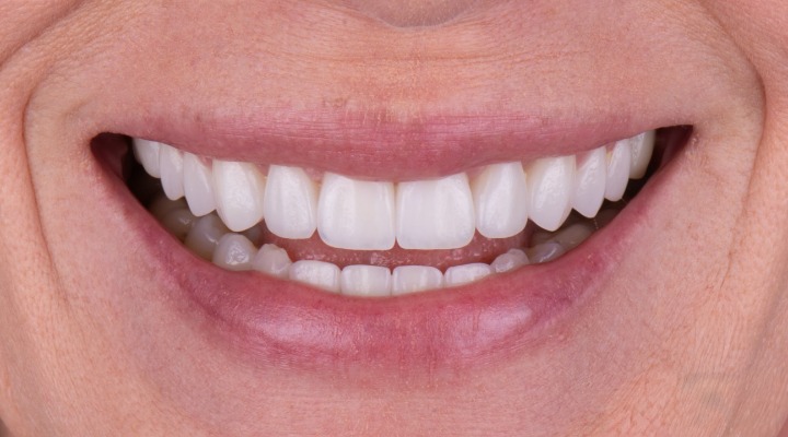 Zirkonyum Kaplama Yaptıranlar ve Yorumları