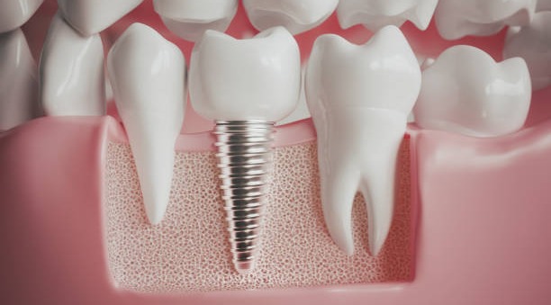 İmplant Yaptıranlar