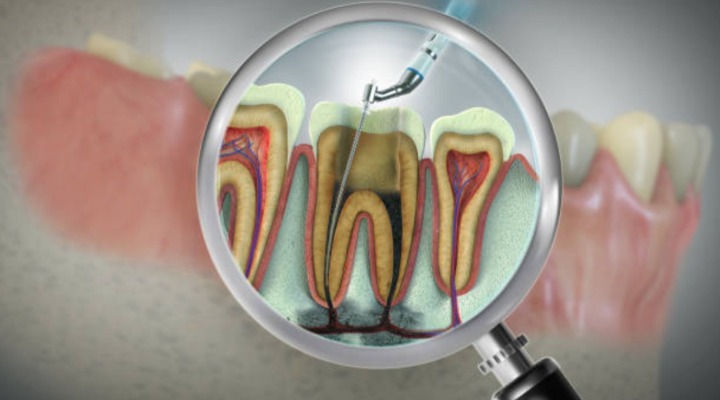 Kanal Tedavisi Nedir, Nasıl Yapılır? | Ağrısız Endodontik Tedavi Rehberi